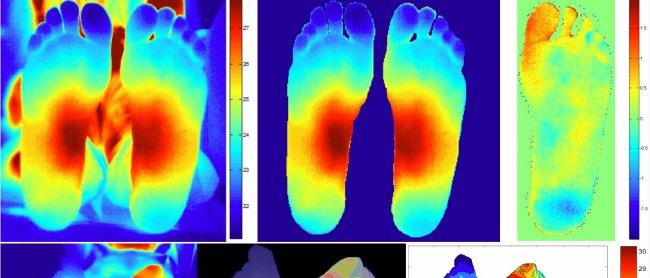 Imágenes en infrarrojo para la evaluación del pie diabético.