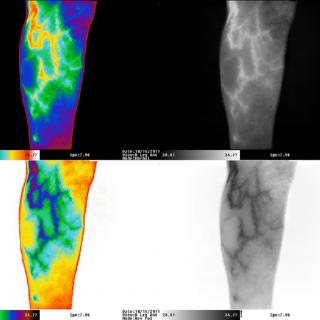 Medical aplications of imaging Thermographic image of human body